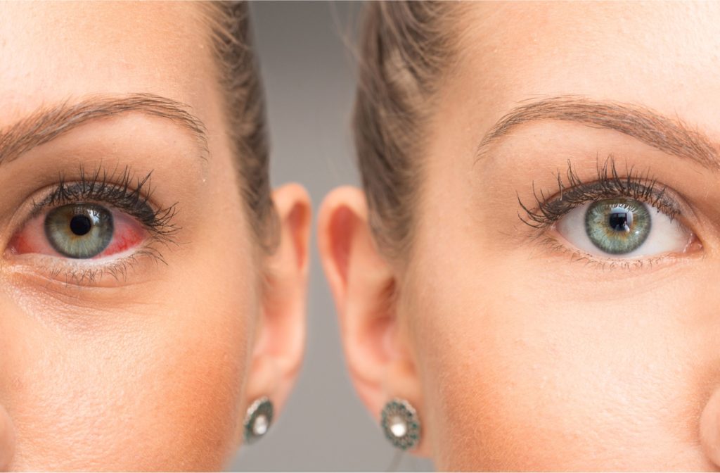 Mirror image of a woman's face showing irritated eye on the left side and normal eye on the right.