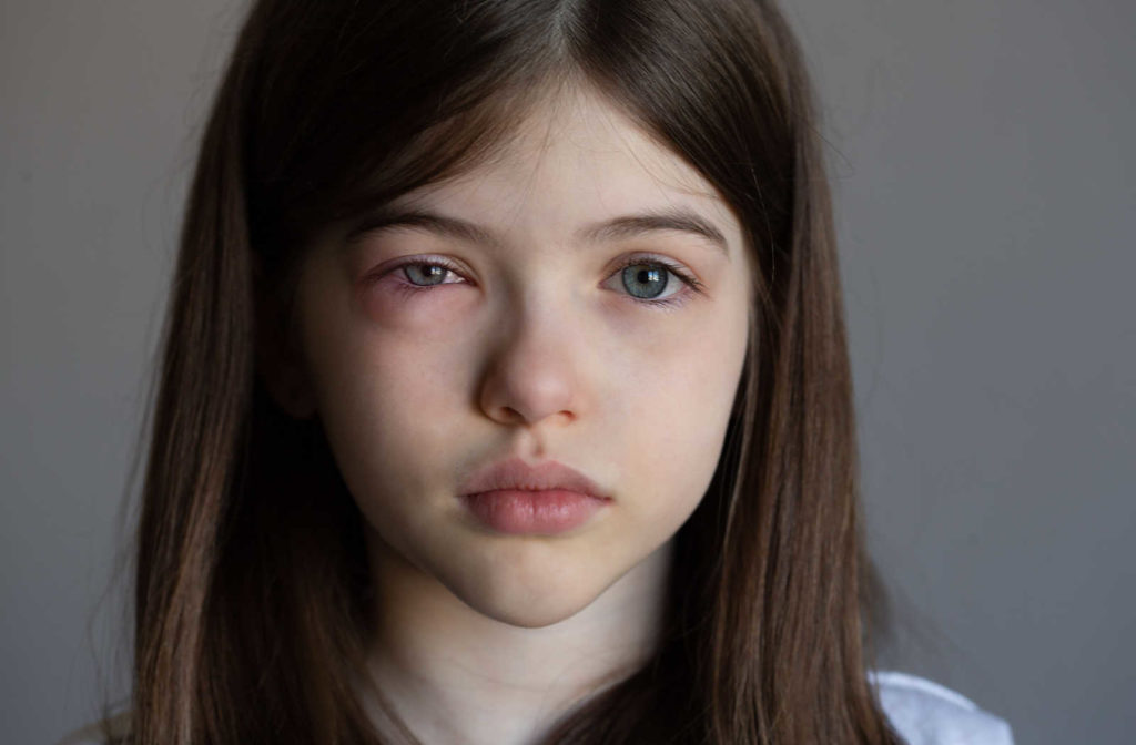 A close-up of a young girl with a red blood eye affected by conjunctivitis.