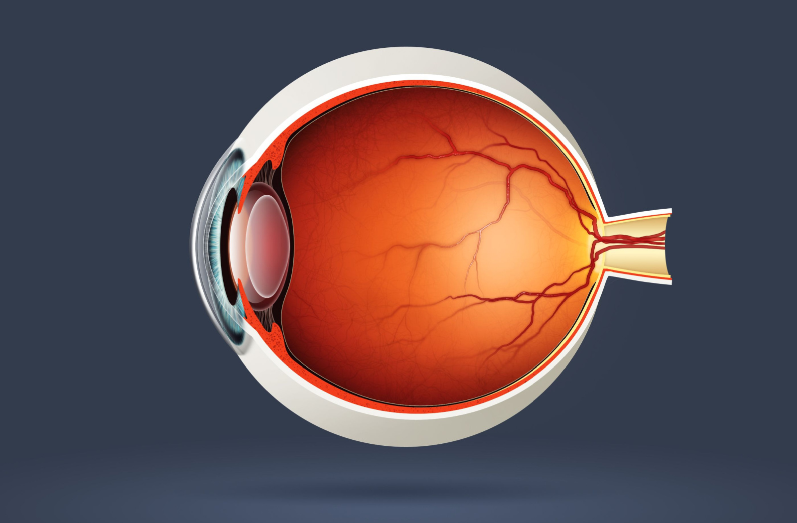 What Causes Retinal Detachment?