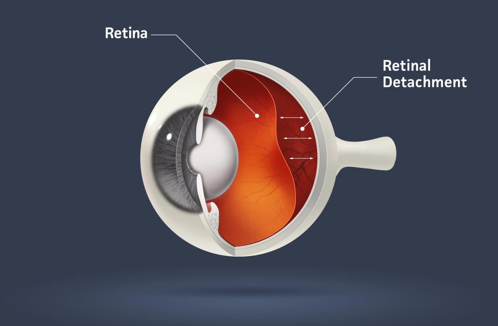 Digital drawing of an eyeball cross section showing retinal detachment, 