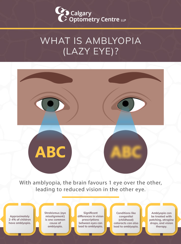 Infographic about the primary causes amblyopia