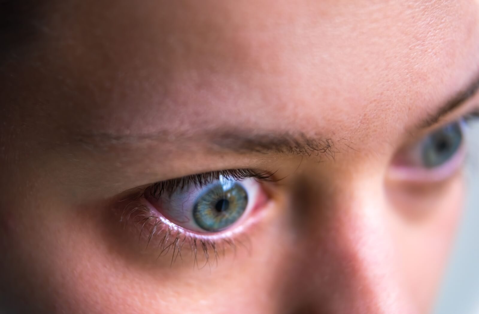 Close-up of a person with bulging eyes due to Graves' Eye Disease.