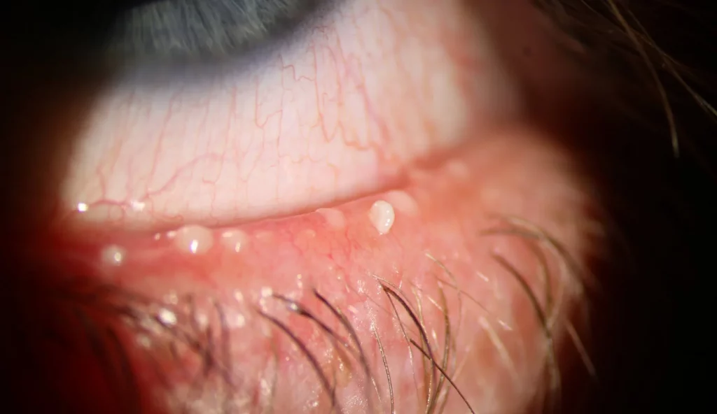 Poor quality secretions in a dysfunctional meibomian gland.
